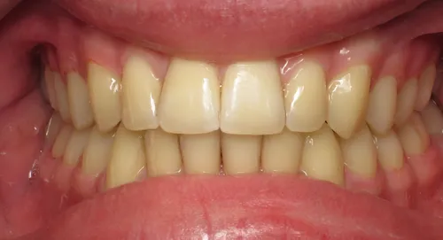 After - Patient smile transformation 2