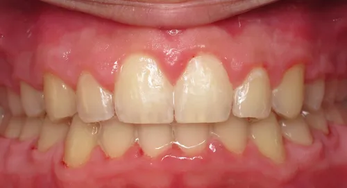 After - Patient smile transformation 4