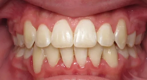 After - Patient smile transformation 5