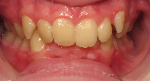 Before - Patient smile transformation 1