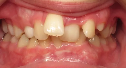 Before - Patient smile transformation 2