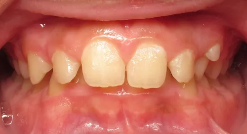 Before - Patient smile transformation 4
