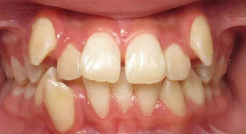 Before - Patient smile transformation 5
