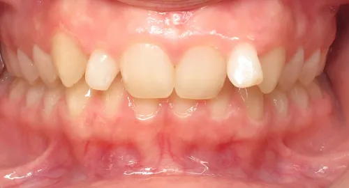 Before - Patient smile transformation 6
