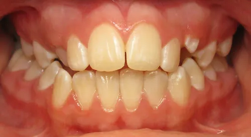 Before - Patient smile transformation 8