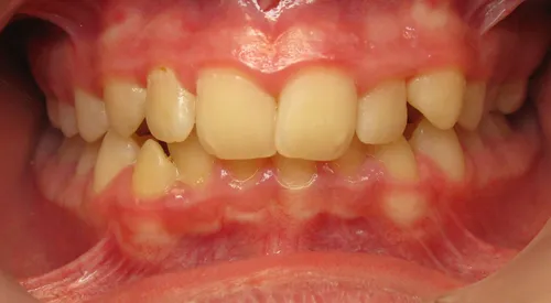 Before - Patient smile transformation 9