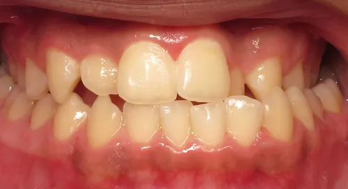 Before - Patient smile transformation 10